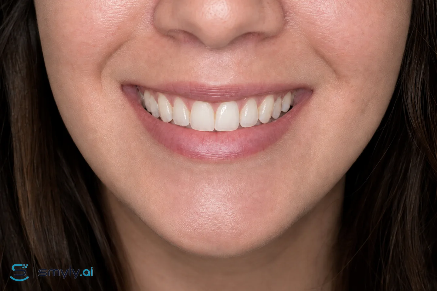 After: Smyly simulation of small tooth buildup on the same smile