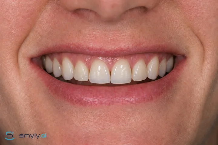 After: Smyly porcelain veneers simulation